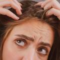 Dermatolog Kosović: Ne zanemarujte prhut - ako je ne liječite moguć je gubitak kose