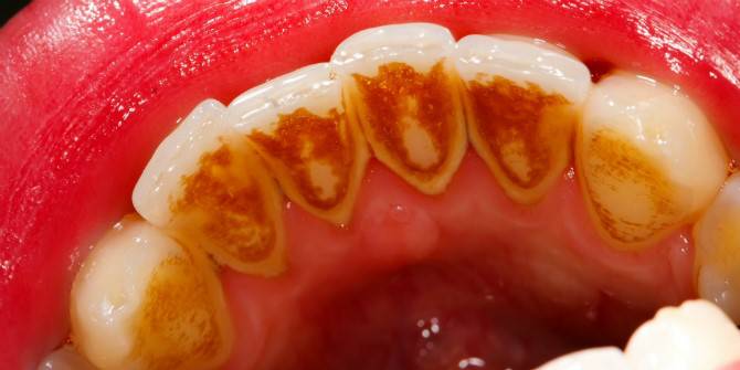 Muči li vas zubni kamenac koji se stalno stvara? Evo kako ga se riješiti kod kuće