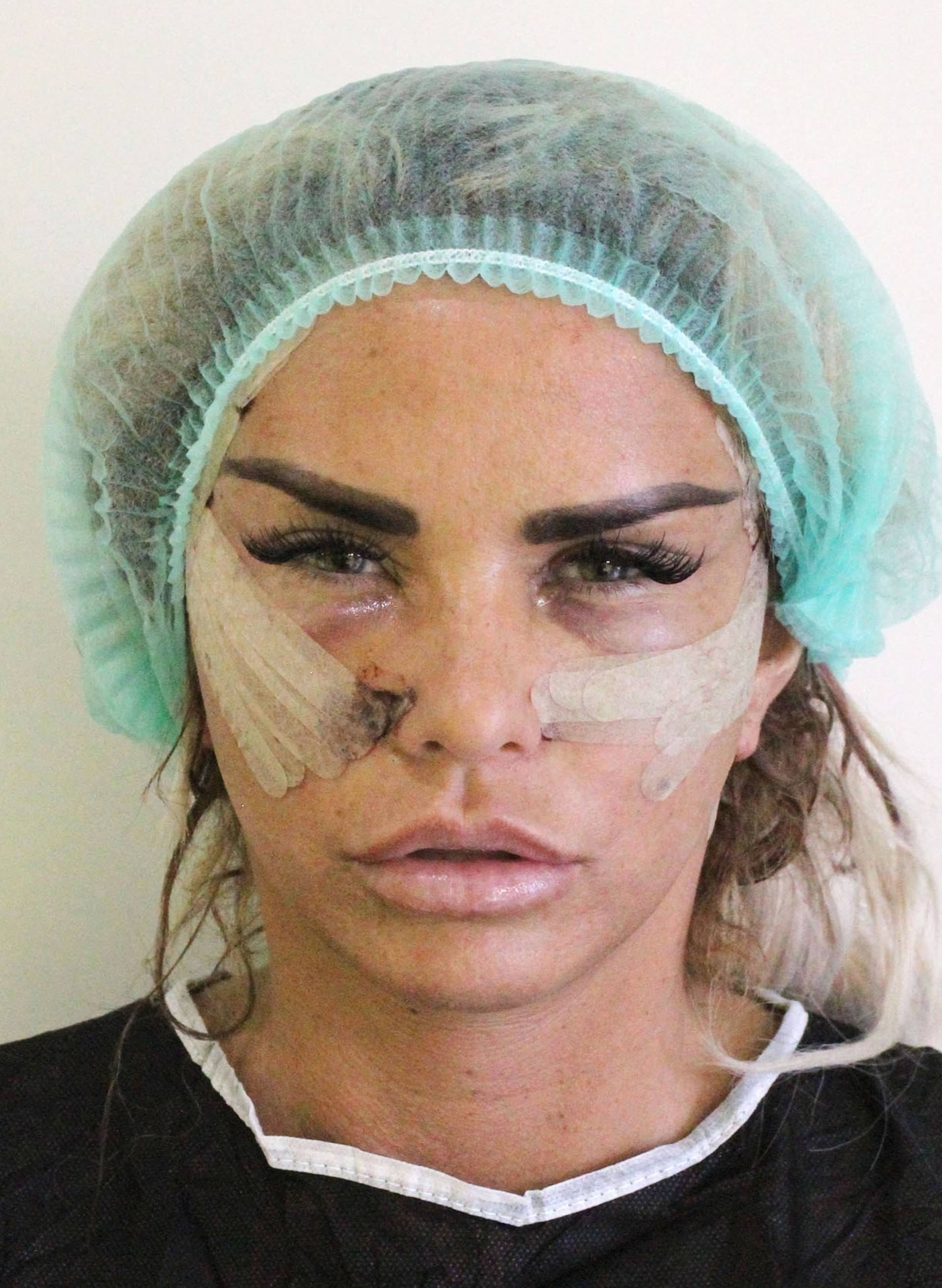 *PREMIUM-EXCLUSIVE* Former Glamour Model Katie Price Aka Jordan goes under the knife as she's pictured looking in discomfort after having surgery done in Turkey. *MUST CALL FOR PRICING*