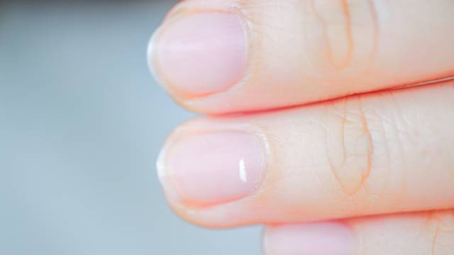 Znate li što znače bijele mrlje na noktima i kako ih se riješiti?