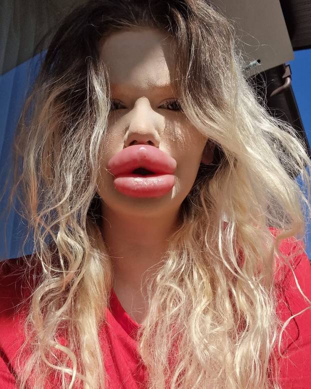 FOTO Žena s najvećim usnama na svijetu otkrila kako je nekoć izgledala: Šok! Bila si prekrasna