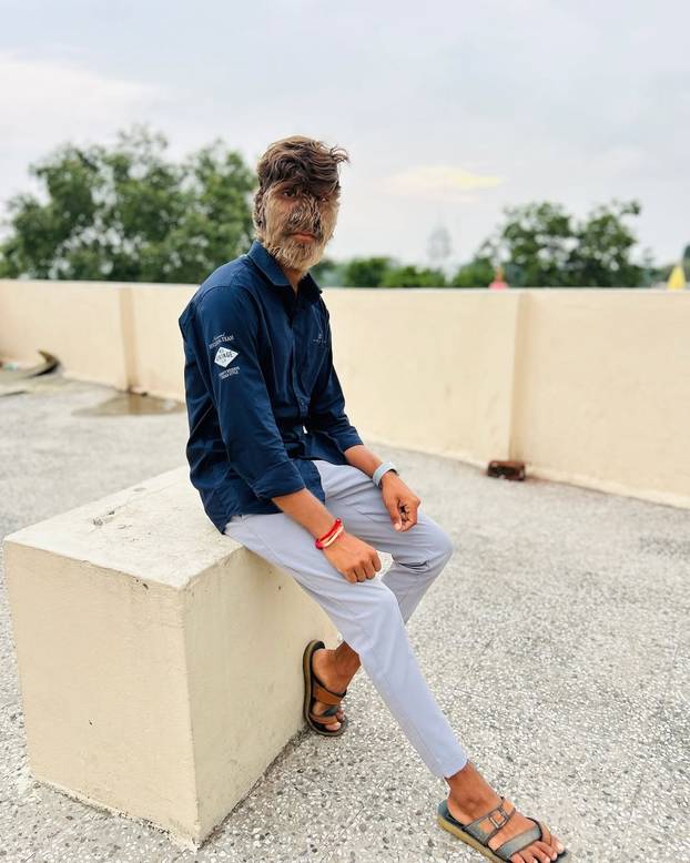 FOTO Ovaj mladić (18) pati od sindroma vukodlaka: U školi me sprdaju, ali volim svoje dlake...