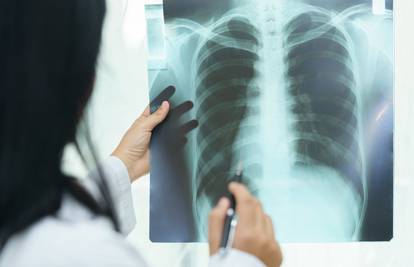 Kratki dah, problemi s plućima: To čeka one koji prebole virus?