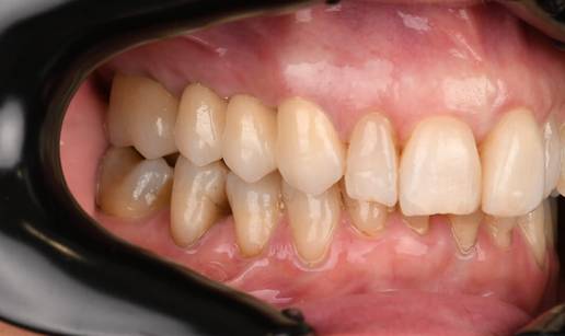 Dentalni implantat ili most &ndash; &Scaron;to je bolji izbor?