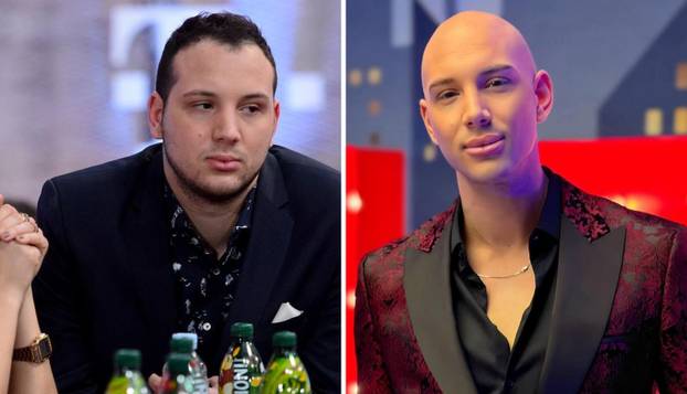 FOTO Stručnjaci o presađivanju kose: 'U Turskoj je to bilo dosta sumnjive kvalitete...'