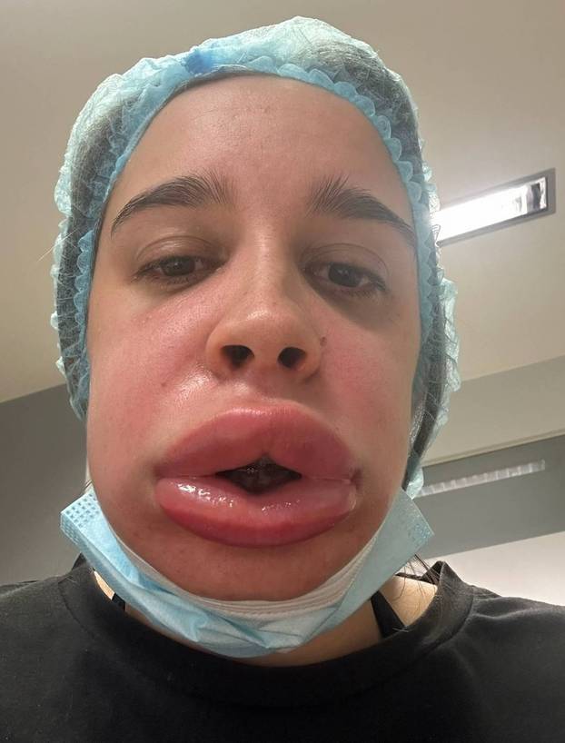 EXCLUSIVE: Woman dubbed ‘blobfish’ as lip filler removal goes wrong