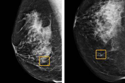 Novi program bolji u dijagnozi raka dojke od samih radiologa