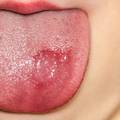 Rane u ustima nisu bezopasne, mogu biti zdravstveni alarm!