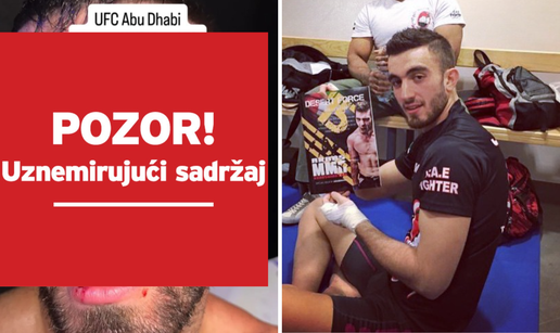 UZNEMIRUJUĆE Strašne ozljede UFC borca! Dobio je rekordne batine i izašao neprepoznatljiv
