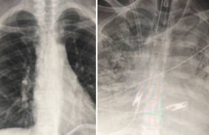 Ovo su pluća dva pacijenta koji imaju koronu. Jedan se cijepio, drugi nije. Razlika je ogromna