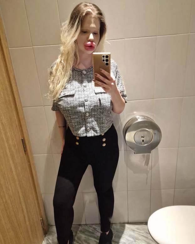 FOTO Andrea ima najveće usne na svijetu: Teško se smijem, ali ne mislim stati s operacijama...