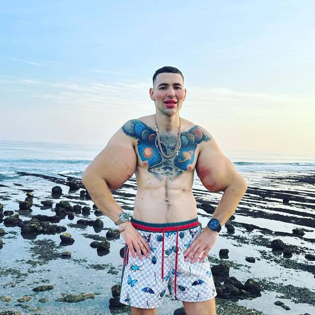 FOTO 'Ruski Popaj' mogao bi izgubiti obje ruke zbog teške infekcije: Ubrizgava kemikalije!