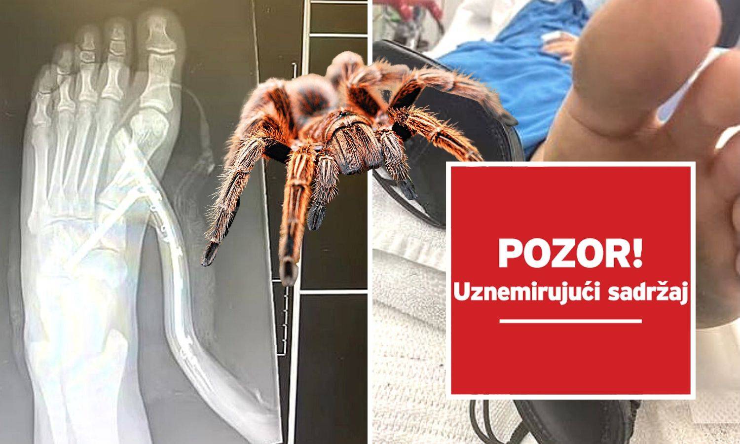 Vidjela pauka i skočila na štiklu, peta joj ušla u nogu! Doktori su bili u čudu: 'Kako ste to uspjeli?'