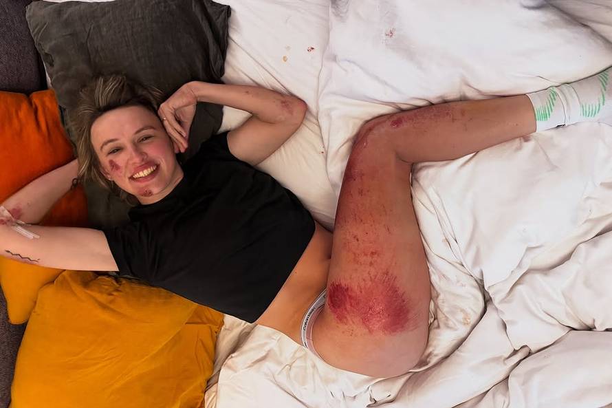 VIDEO Biciklistkinja pozirala u donjem rublju i otkrila ozljede: 'Imam prilično čvrste kosti'