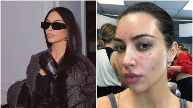Kim Kardashian progovorila o svojoj borbi s kožnim bolestima