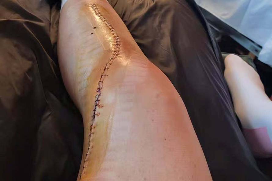 Najbolja skijašica svijeta otkrila posljedice dvostrukog prijeloma noge: 'Moglo je biti i gore'