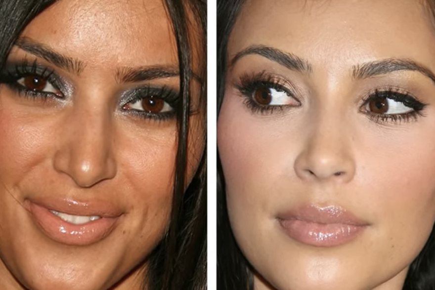 Plastične operacije Kardashian klana