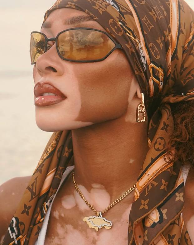 FOTO Rugali su joj se zbog bolesti, a danas je obožavaju zbog jedinstvenog izgleda