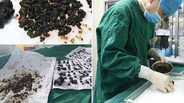 Liječnici u šoku: Ženi iz tijela izvukli više od 200 kamenčića