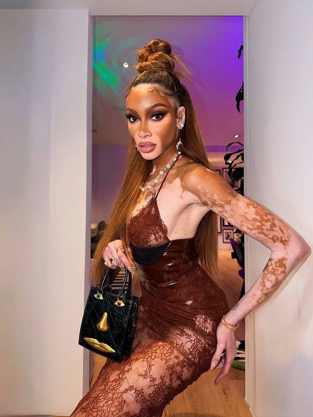 FOTO Rugali su joj se zbog bolesti, a danas je obožavaju zbog jedinstvenog izgleda