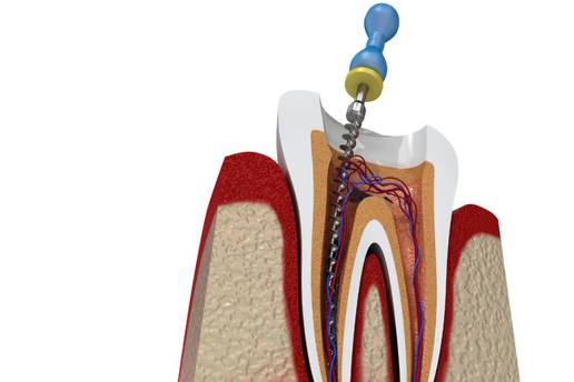Za&scaron;to je endodoncija klju&ccaron;na za o&ccaron;uvanje prirodnog zuba