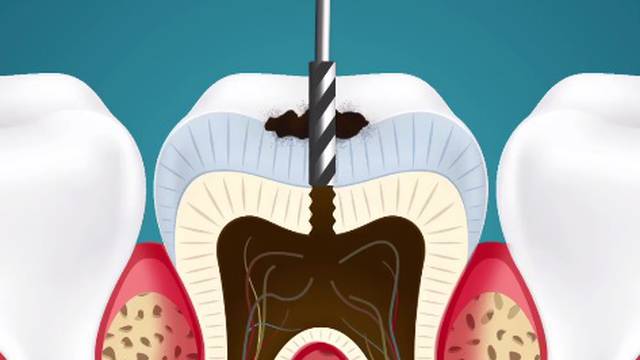 Super animacija: Evo što zubar radi dok vam popravlja zube