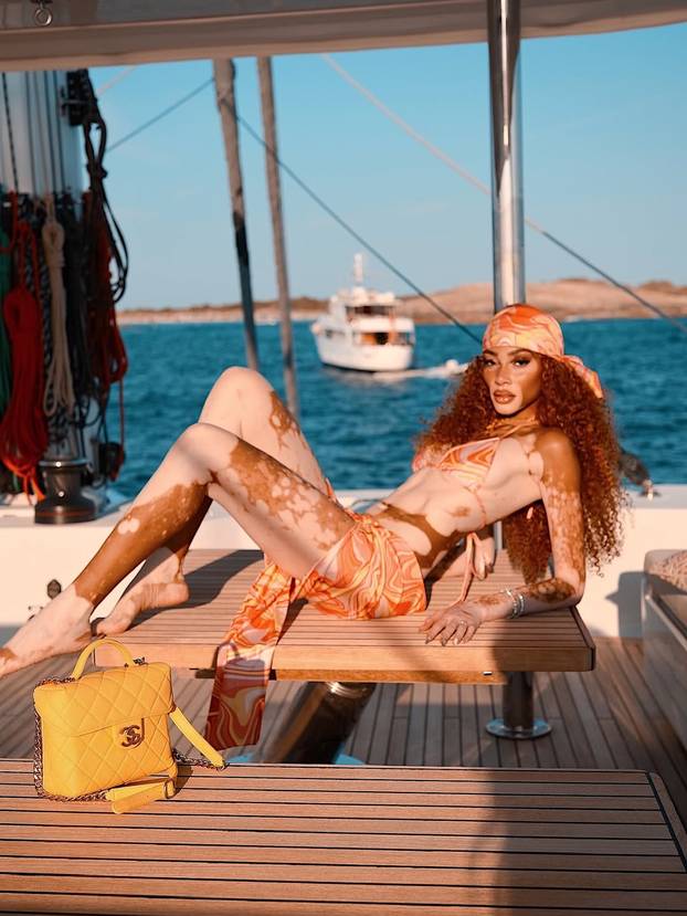 FOTO Rugali su joj se zbog bolesti, a danas je obožavaju zbog jedinstvenog izgleda