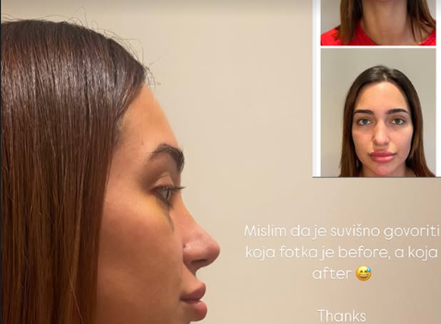 Laura iz 'Savršenog' operirala je nos: Pogledajte što je sve radila na sebi i kako se mijenjala...