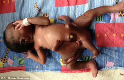 'Parazitski blizanac': Maleni se rodio s četiri ruke i četiri noge