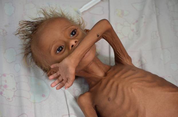 Malnourished boy lies on a bed at a hospital in the Red Sea port city of Houdieda