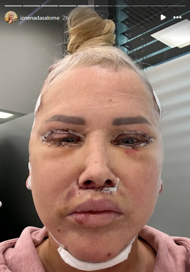 FOTO Prva je u Hrvatskoj pričala o promjeni spola: Salome je išla na facelifting, evo kako izgleda