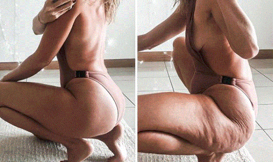 Ista žena ima celulit pa ga više nema: Samo sam se pomaknula