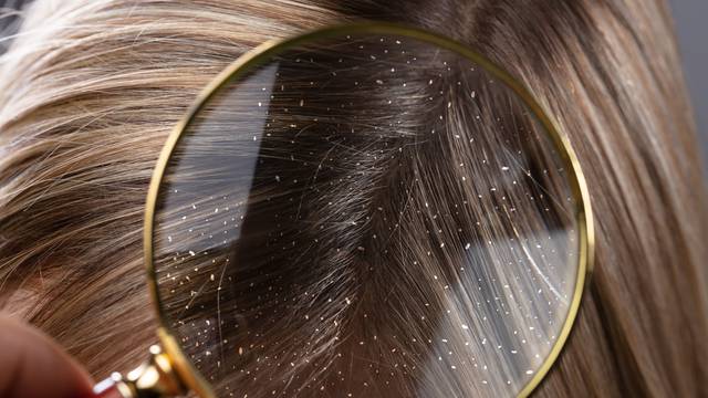 Dermatolog: Perut treba liječiti, jer može izazvati ispadanje kose