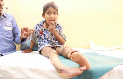 Ne osjećaju bol: Brat i sestra si zbog rijetke bolesti pojeli prste