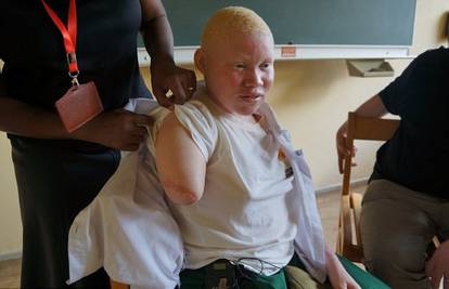 Šokantna priča albino žene: 'Mačetom su mi odsjekli ruku'