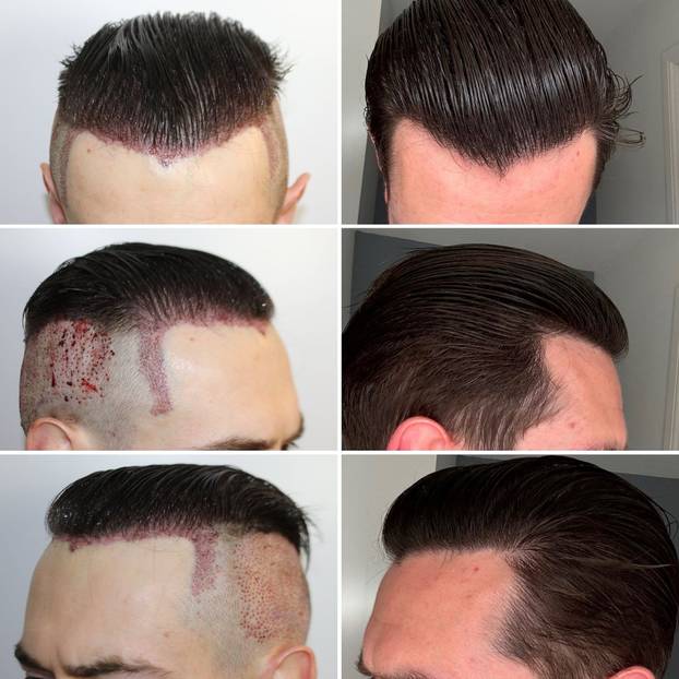 FOTO Stručnjaci o presađivanju kose: 'U Turskoj je to bilo dosta sumnjive kvalitete...'