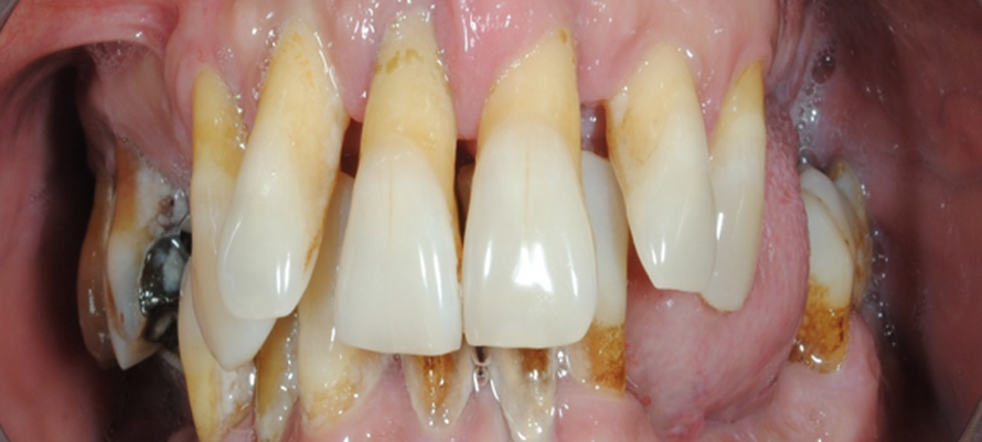 “Strategic” implantologijom do savrešenog osmijeha