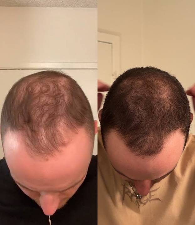 FOTO Stručnjaci o presađivanju kose: 'U Turskoj je to bilo dosta sumnjive kvalitete...'