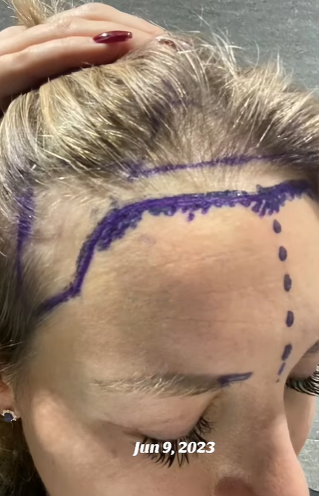 Dosadio joj izgled barbike pa se za 140.000 € 'popravila': Evo kako je izgledala prije zahvata