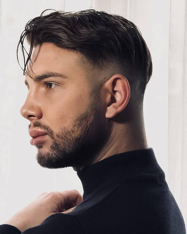 FOTO Stručnjaci o presađivanju kose: 'U Turskoj je to bilo dosta sumnjive kvalitete...'