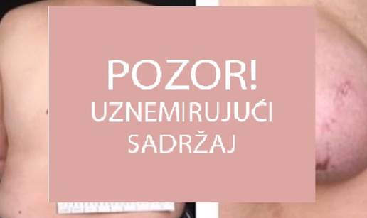 Ženi je narasla 'treća dojka' na leđima, 'bujala' je deset godina