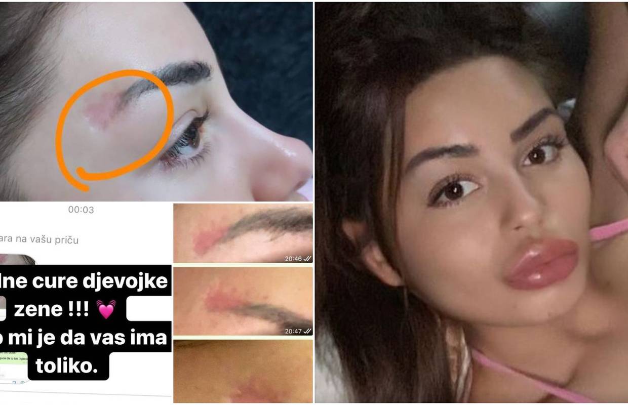 Kristina Mandarina objavila je fotografije ožiljaka: 'Nemojte dozvoliti da vam se ovo dogodi'