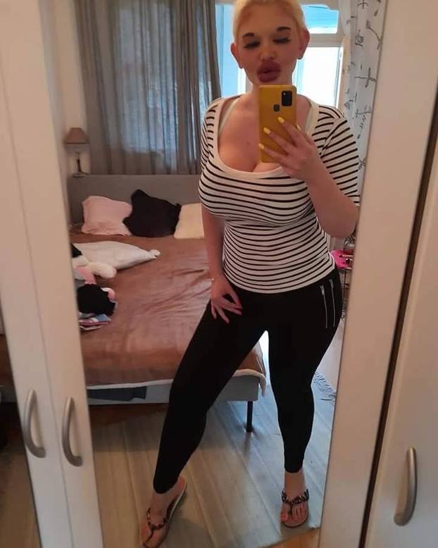 FOTO Žena s najvećim usnama na svijetu otkrila kako je nekoć izgledala: Šok! Bila si prekrasna