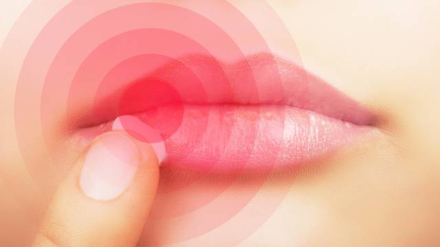 Lips affected by herpes.