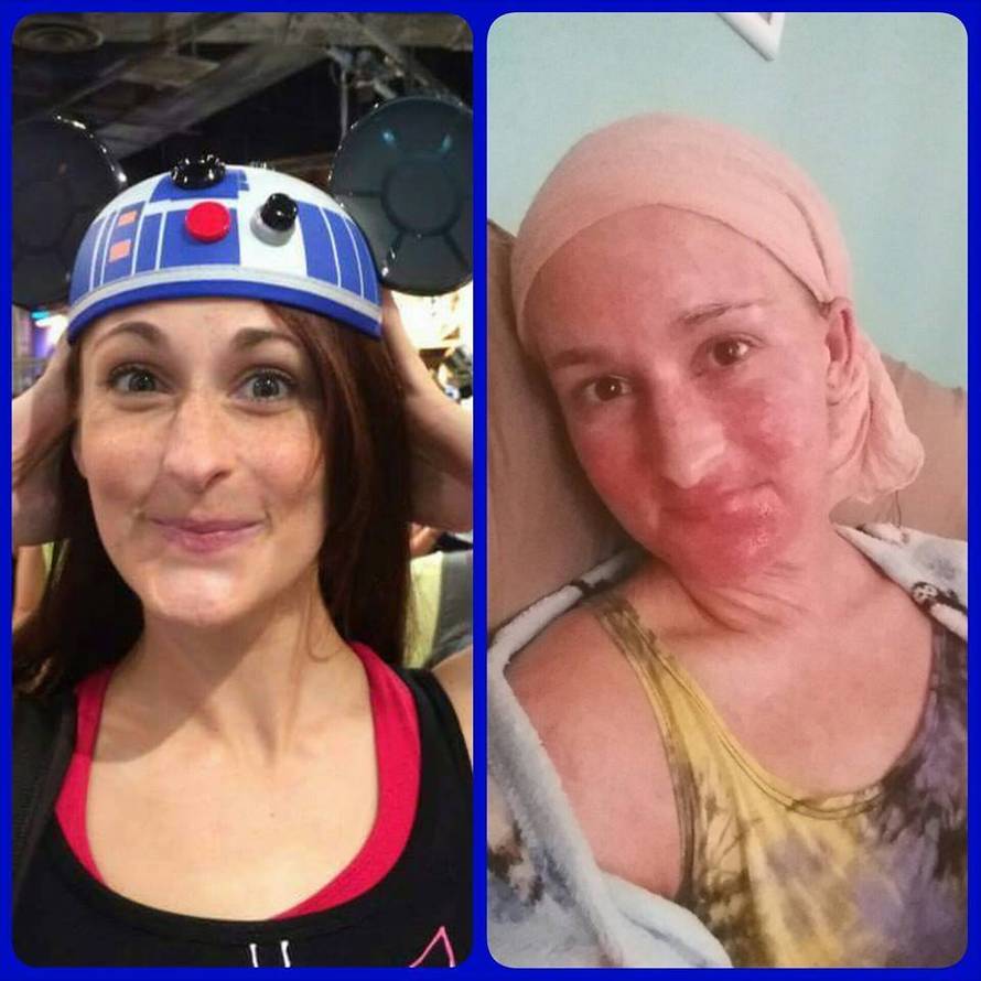 Godinu dana koža joj je gorjela i ljuskala se - sve zbog steroida