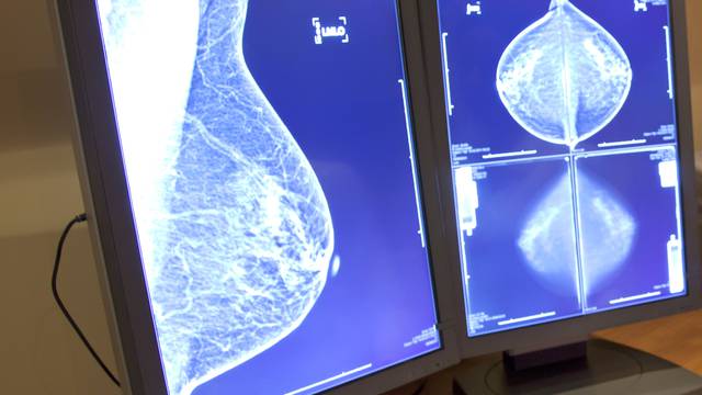 'Sve više žena oboljelih od raka dojke želi na rekonstrukciju'