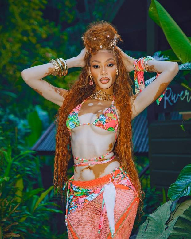 FOTO Rugali su joj se zbog bolesti, a danas je obožavaju zbog jedinstvenog izgleda