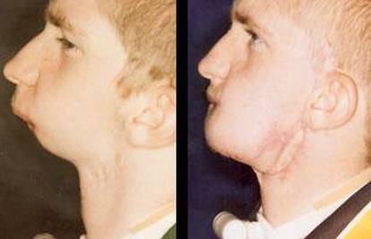 Mladiću  (18) vratili lice  jer je rođen bez brade i vilice