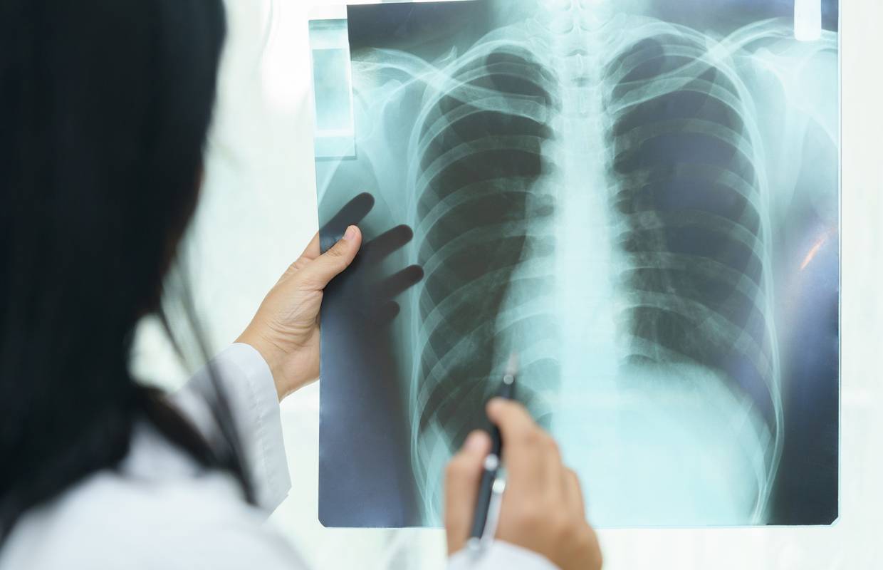 Čine se bezazleni: Ova su dva simptoma prvi znak raka pluća