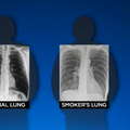 Pluća ljudi koji prebole Covid-19 imaju puno više oštećenja nego pluća dugogodišnjih pušača